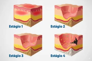 4 estágios lesão por pressão - Escaras