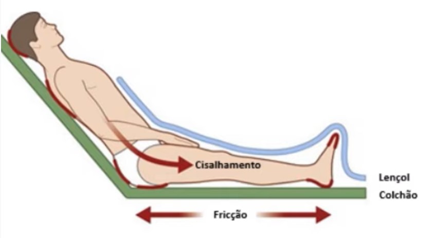 lesão por pressão cisalhamento
