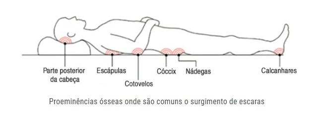 áreas mais comuns para o surgimento da lesão por pressão